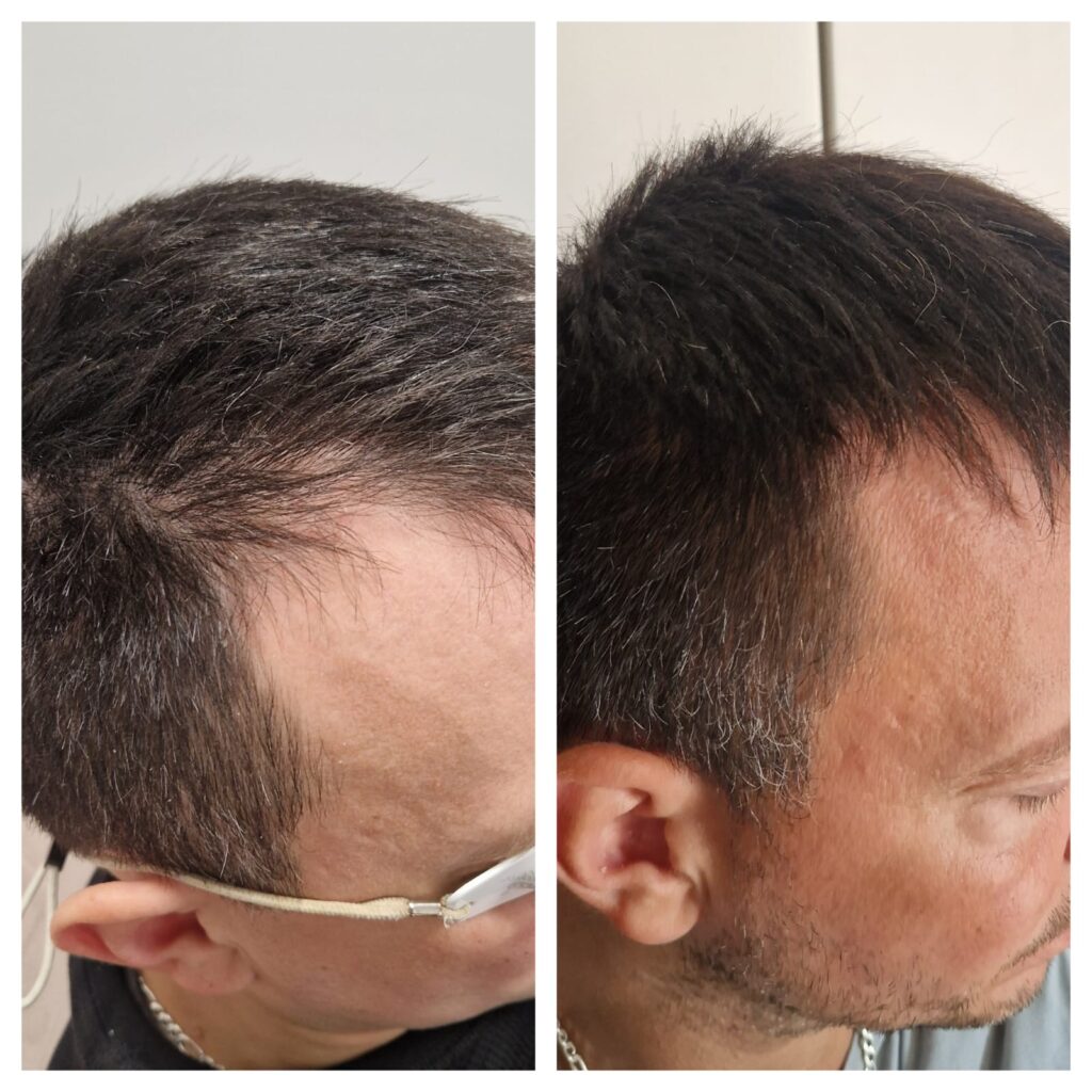 Laserowa terapia łysienia - efekty przed i po kilku zabiegach