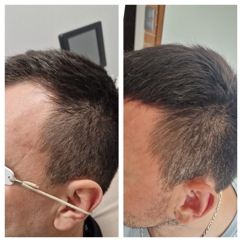 Laserowa terapia łysienia - efekty przed i po zabiegu
