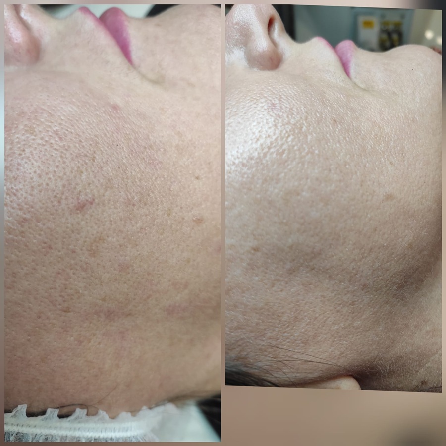 frakcja laserowa - efekty przed i po