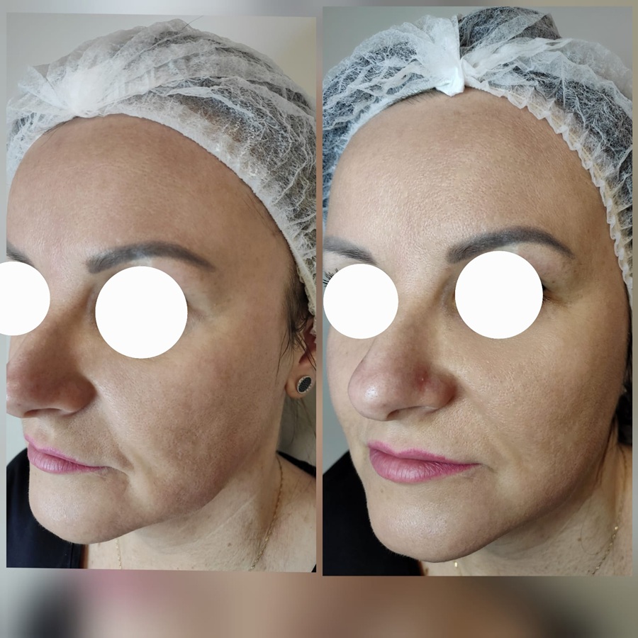 frakcja laserowa - efekty przed i po