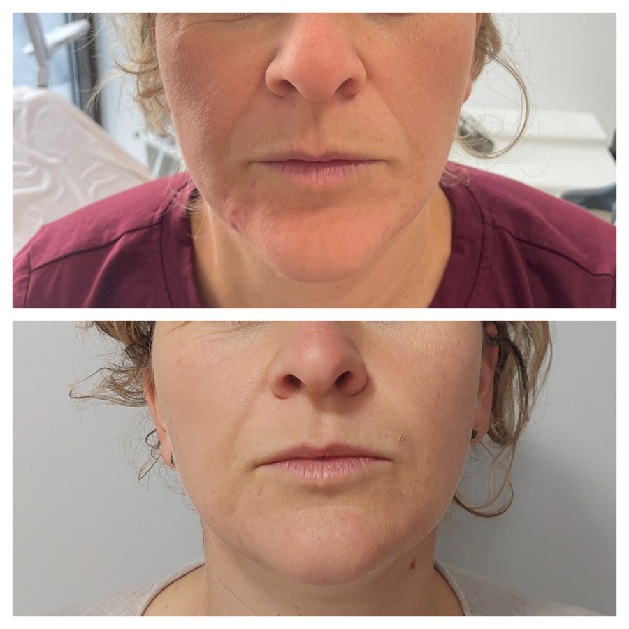 frakcja laserowa - efekty przed i po