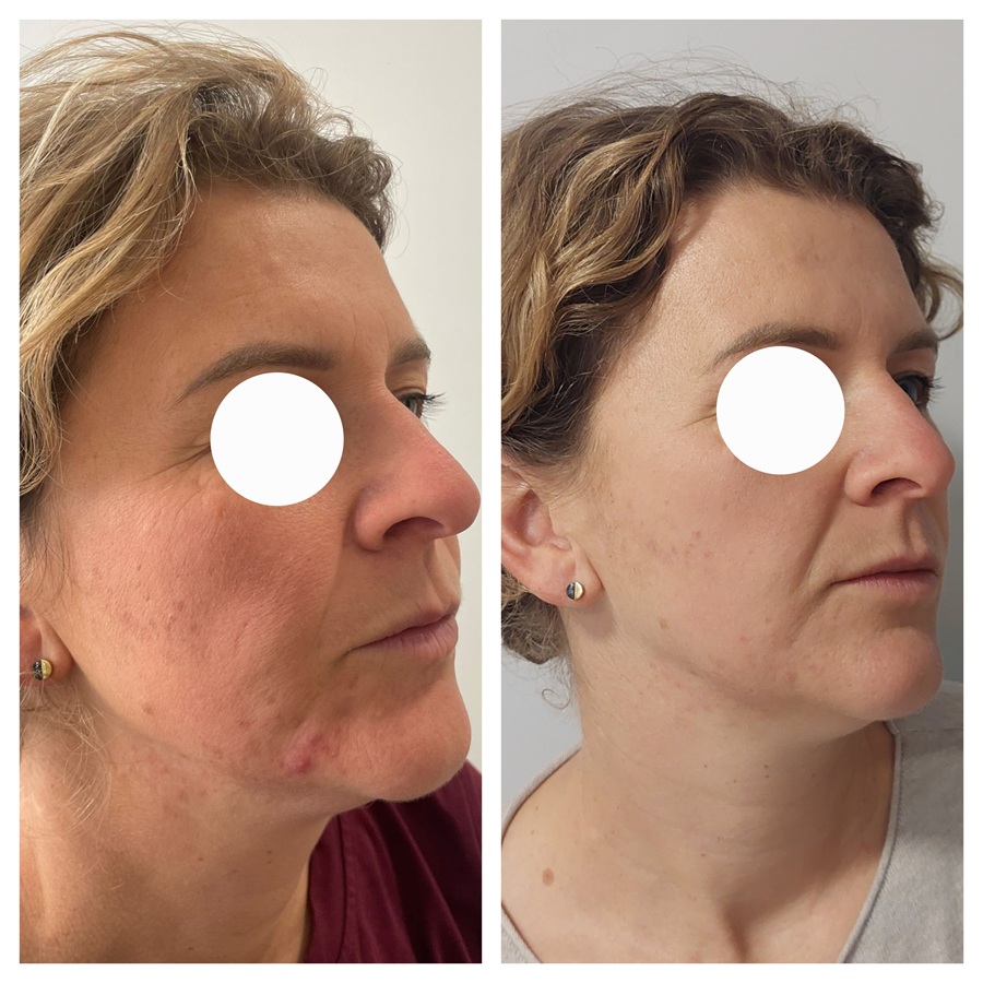 frakcja laserowa - efekty przed i po