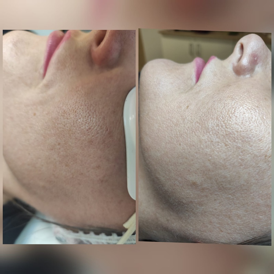 frakcja laserowa - efekty przed i po