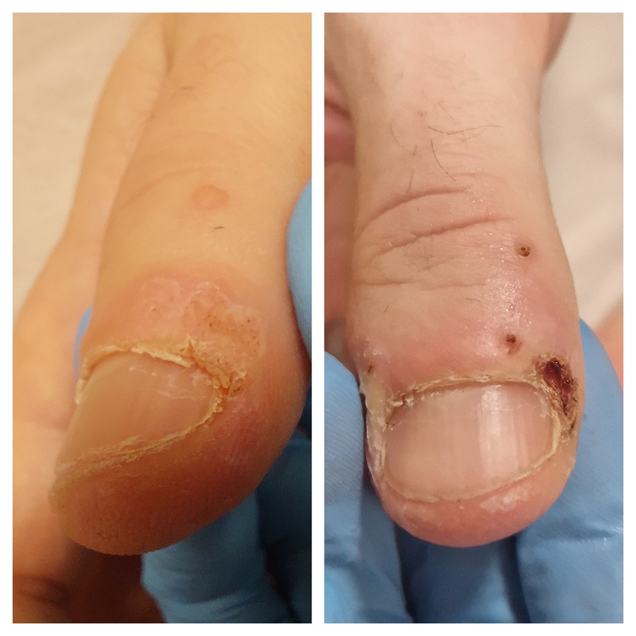 kurzajki - efekty przed i po zabiegu