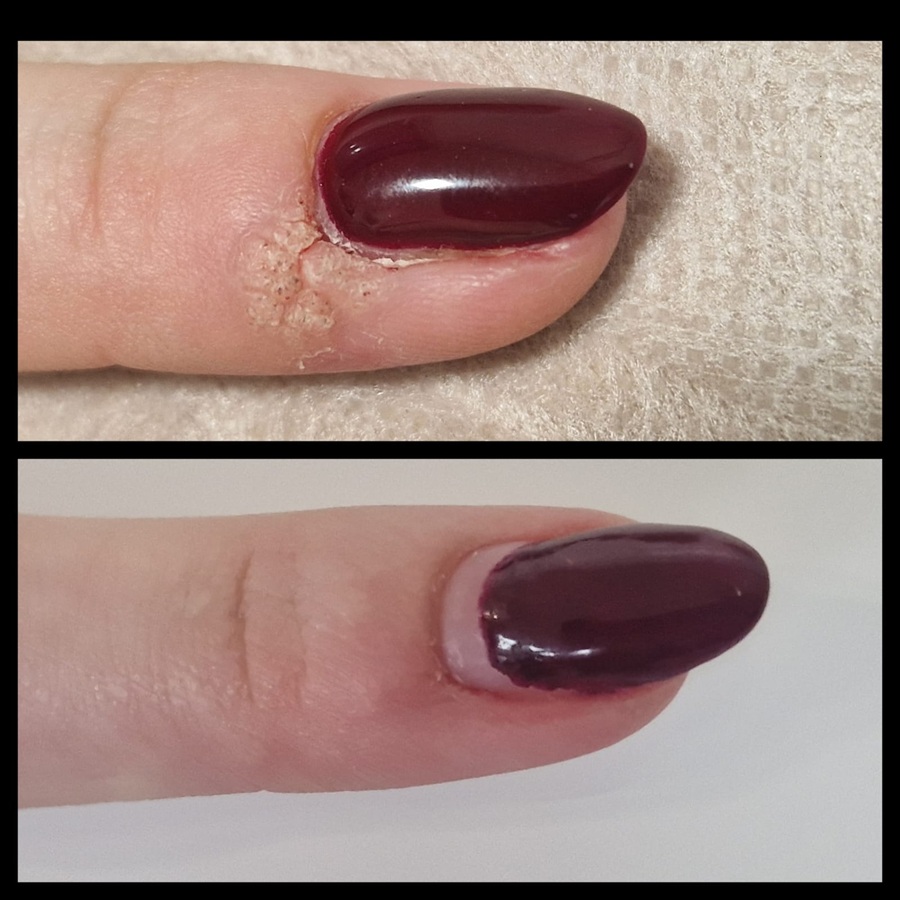 kurzajki - efekty przed i po zabiegu