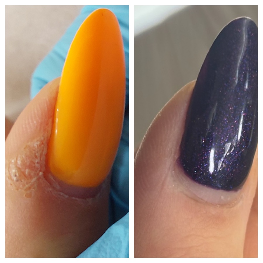 kurzajki - efekty przed i po zabiegu