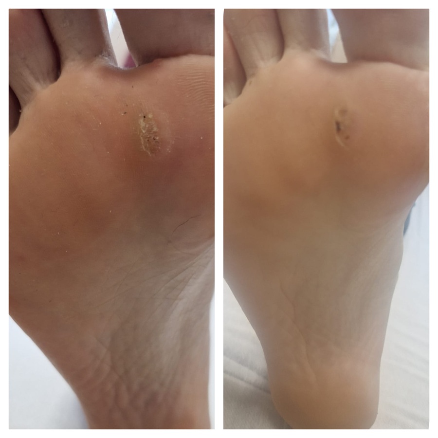 kurzajki - efekty przed i po zabiegu