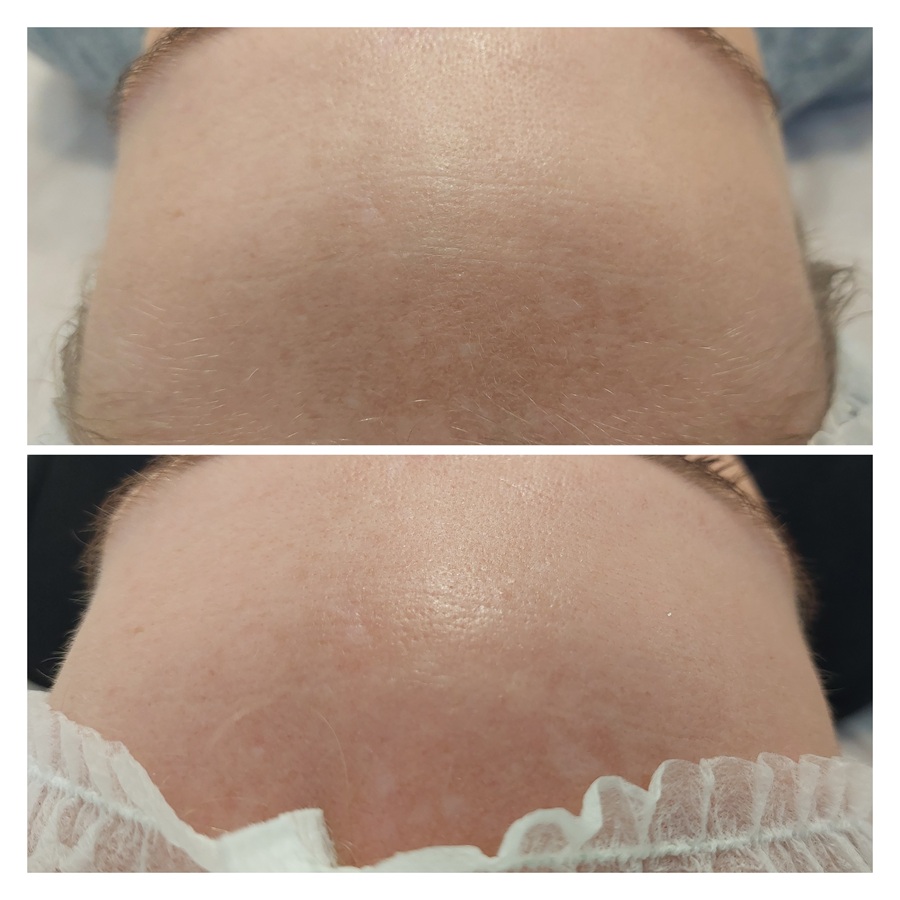 peeling laserowy - efekty przed i po