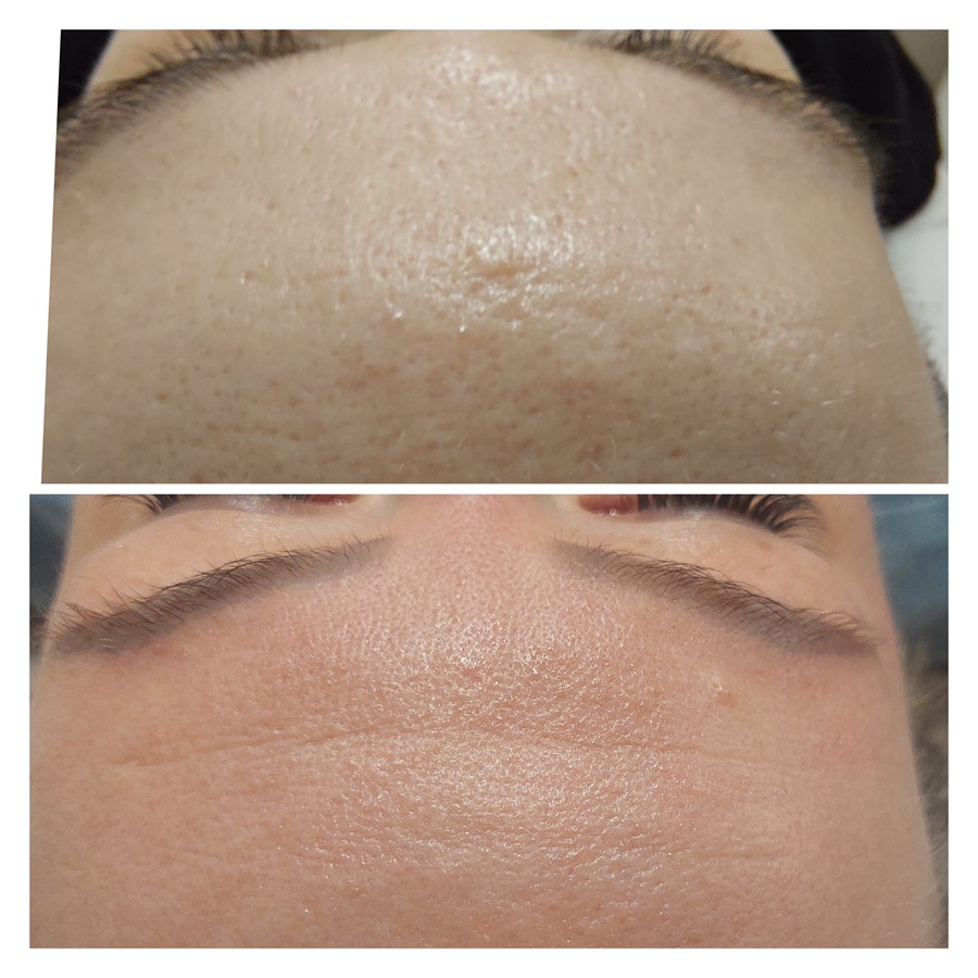 peeling laserowy - efekty przed i po