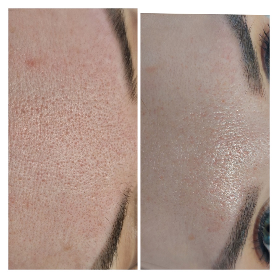 peeling laserowy - efekty przed i po